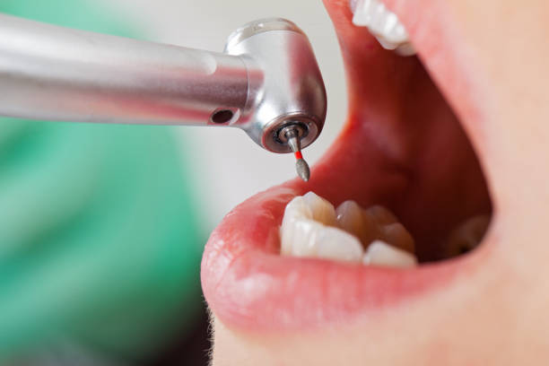 Best Emergency Tooth Extraction in Santa Rosa, CA